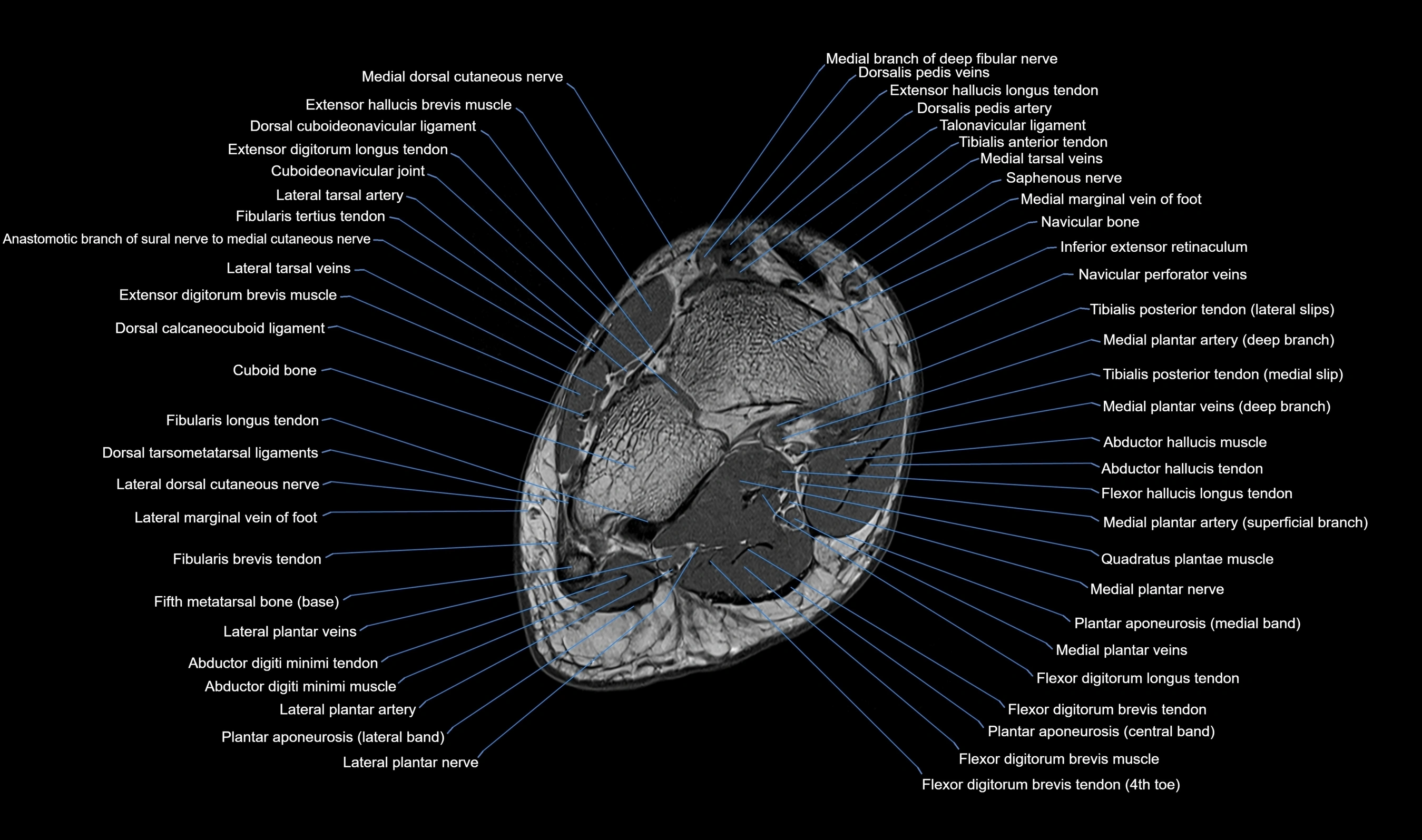 MRI mid foot axial cross sectional anatomy 3T  radiology  image-img-00001-00029.webp